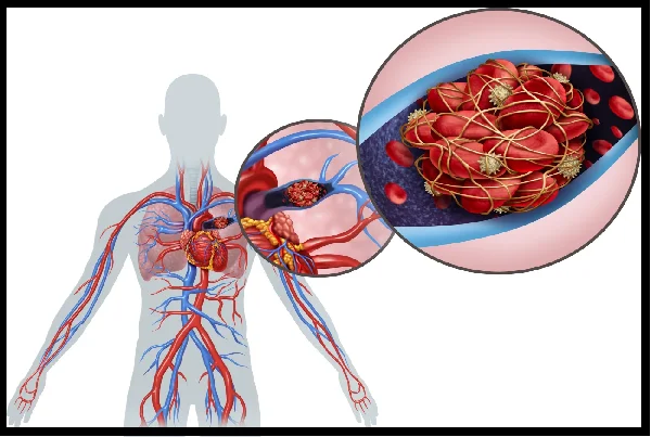 Pulmonary Embolism