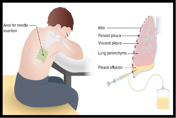Pleural Effusion