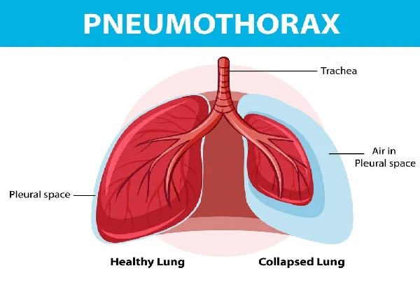Pneumothorax