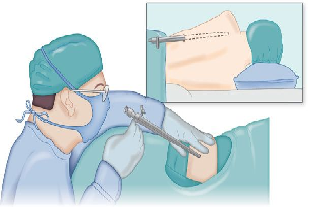 Thoracoscopy With Biopsy