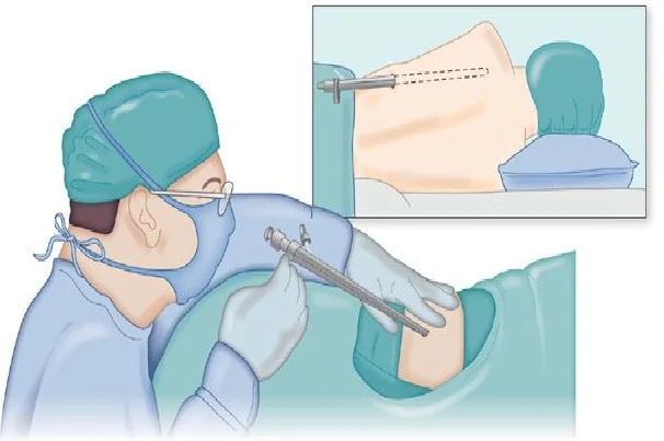 Thoracoscopy With Biopsy